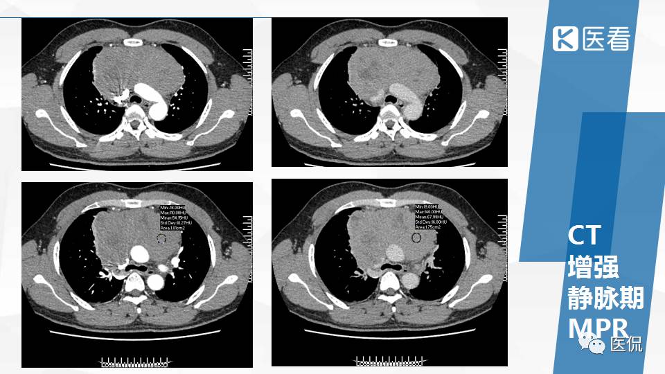 精原细胞瘤ct影像,精原细胞瘤影像特征