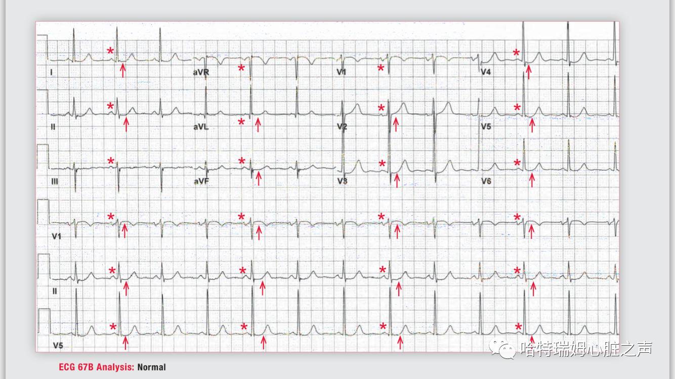 读心有术视频讲解,长期心电图提示下壁st段轻度压低