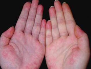 皮肤型红斑狼疮用什么药膏,皮肤型红斑狼疮的饮食