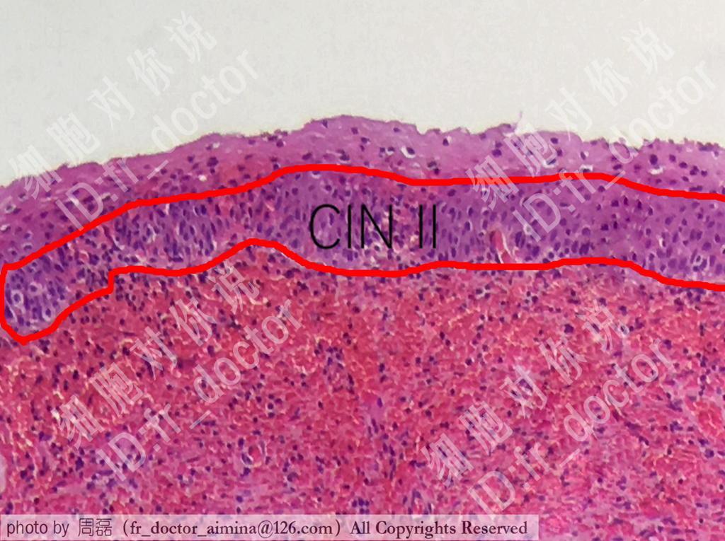 宫颈高度病变镜下观察,宫颈镜下可疑浸润癌严重吗