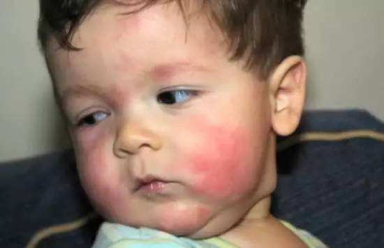 身体周围有螨虫,总觉得到处有螨虫怎么办