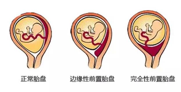 宫外孕大出血是怎么回事,宫外孕大出血前会有征兆吗