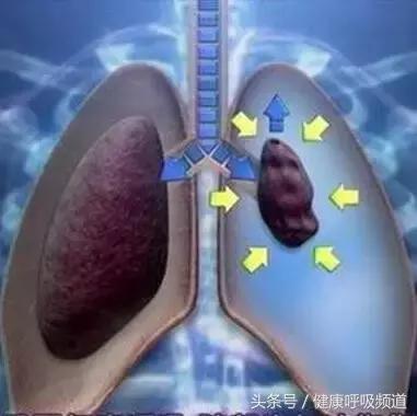 至简清肺仪对肺气肿人有效吗,肺大泡或肺气肿能不能使用清肺仪