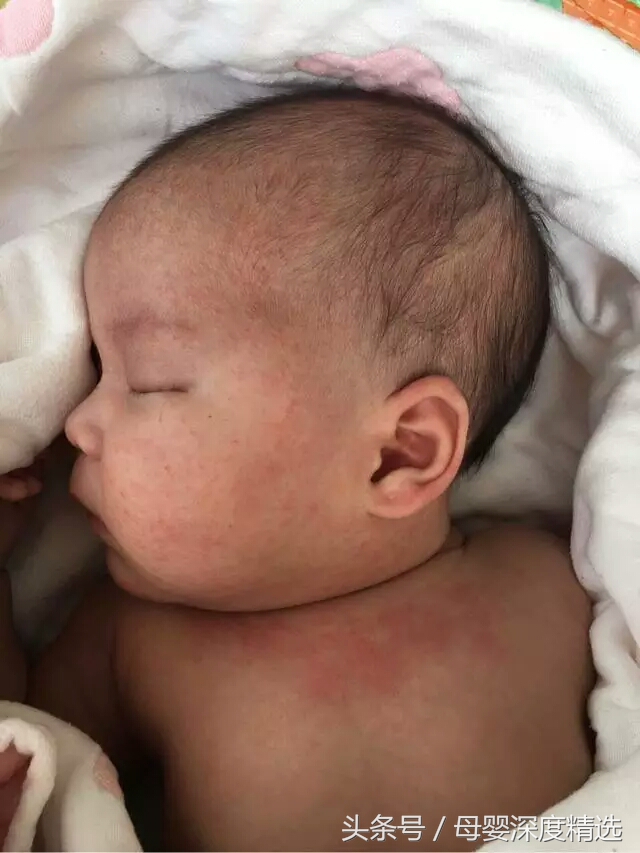 宝宝湿疹该如何有效护理,宝宝湿疹流脓结痂的部分怎么护理