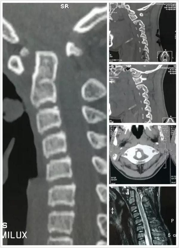 寰枢椎脱位手术适应症,寰枢椎脱位手术最广泛麻醉方法