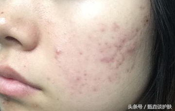 如何去除痘印痘疤痘坑,如何去除痘印留下的痣