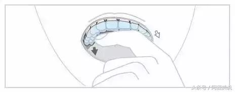 隐适美矫正摘戴攻略,隐适美和正雅隐形矫正哪个好