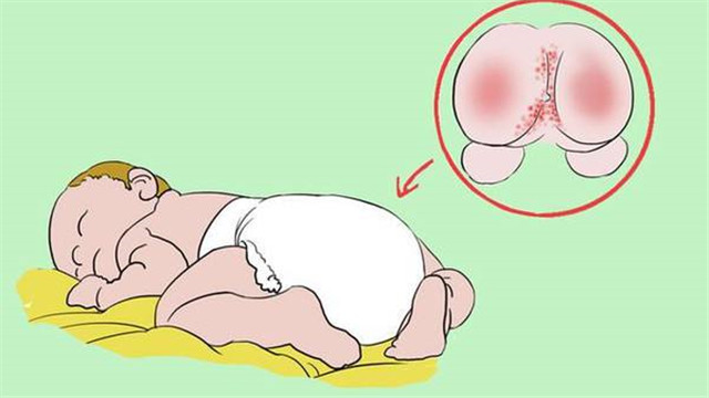 宝宝红屁股起湿疹反复怎么办,宝宝红屁股反复能用炉甘石吗