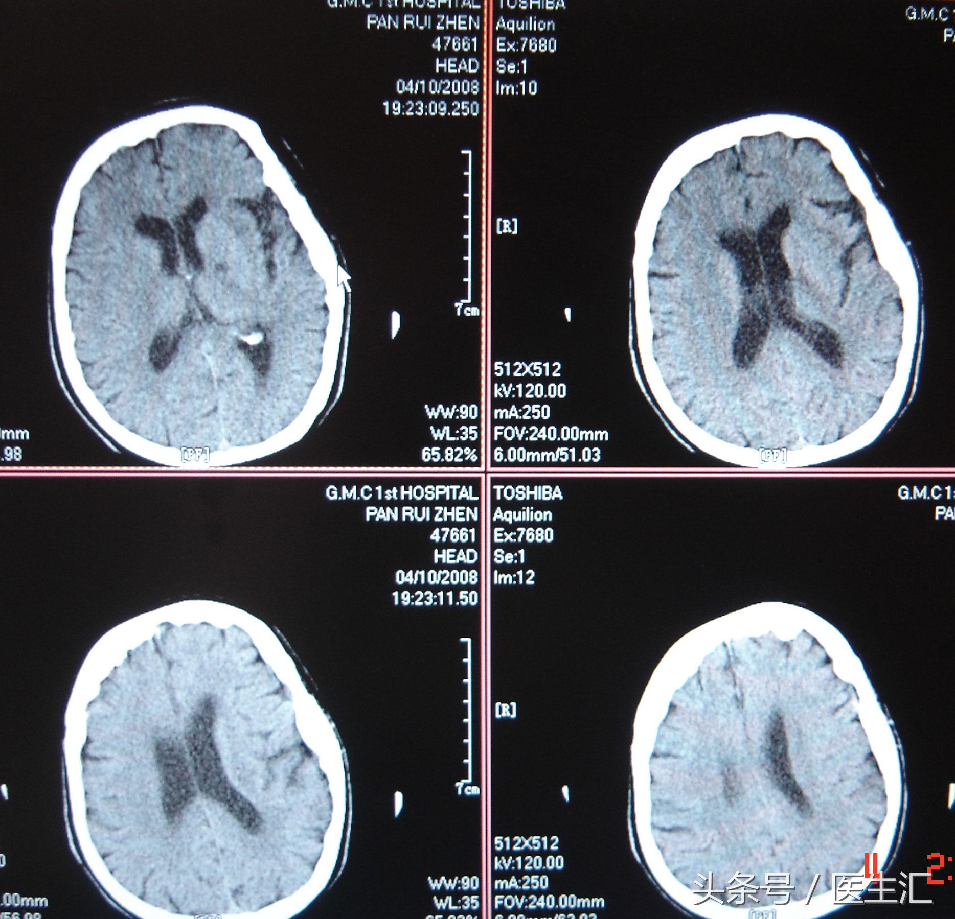 脑溶栓治疗一般多少钱,溶栓治疗需要多少费用