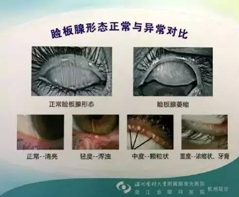 眼睛干涩有异物感是什么病,眼睛干涩迎风流泪属于什么病