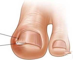 脚趾甲里又长了一层脚趾甲怎么办,脚趾甲往肉里长有啥好办法