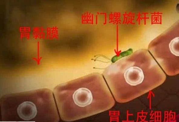 幽门螺旋杆菌食疗最好的方法,小孩感染幽门螺旋杆菌怎么食疗