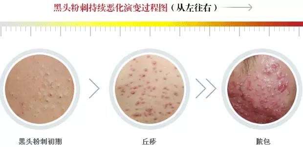 疮疡是什么病引起的,疮疗的后遗症怎么治疗