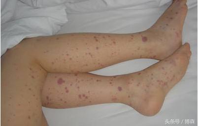 北京协和医院治疗紫癜怎么样,北京哪家医院看儿童过敏性紫癜好