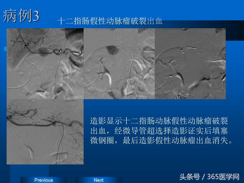 崔进国：消化道出血的介入治疗