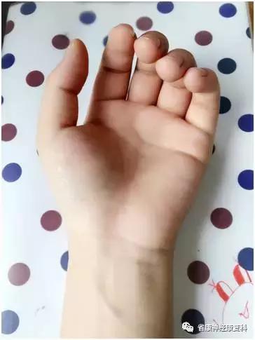 手受外伤不能吃什么,手外伤的康复治疗目标