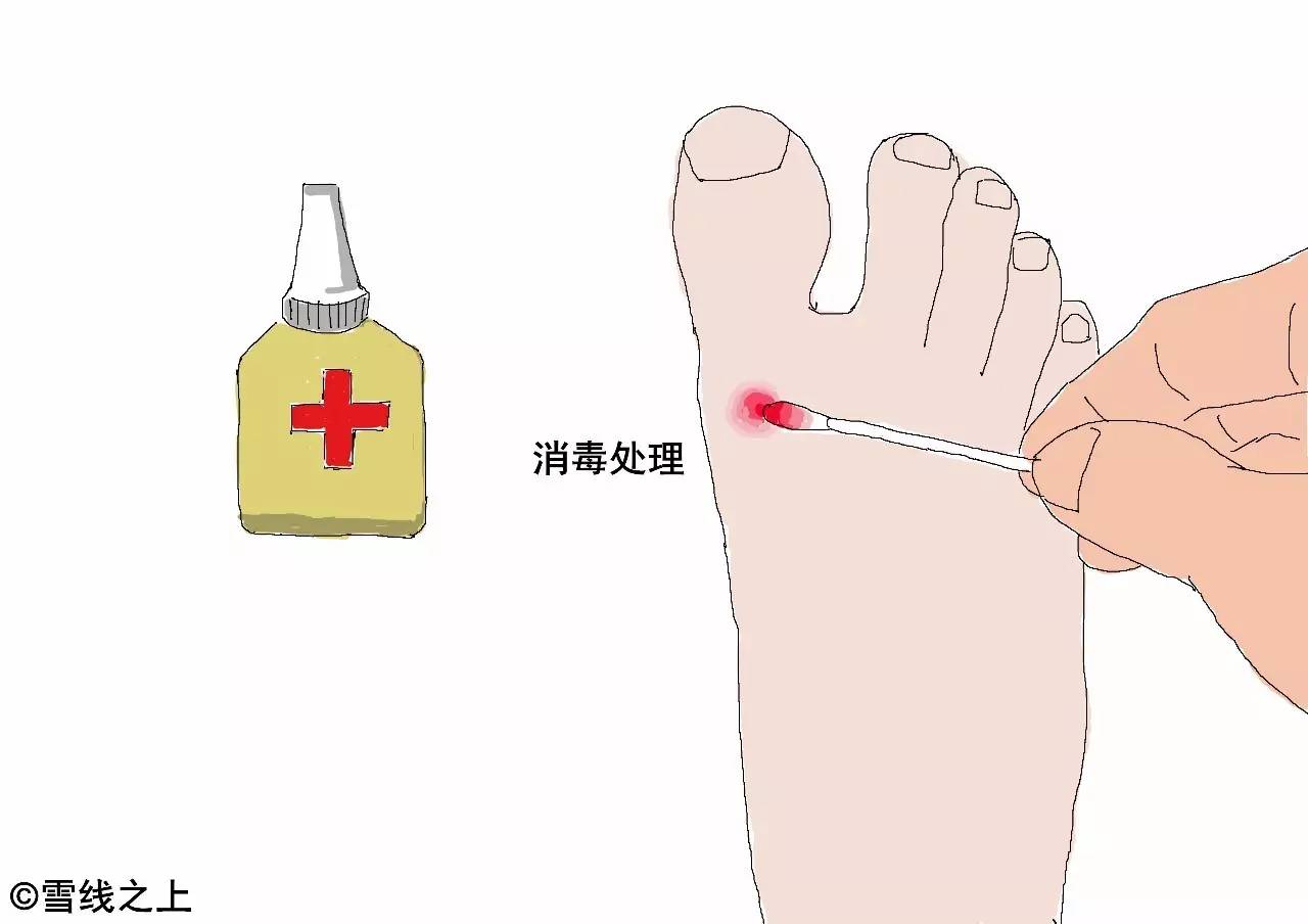 徒步走线时，如何防治水泡？