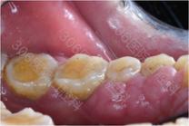 牙龈不增生的降压药,降压药引起的牙龈增生会好吗