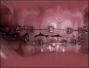 拔牙矫正过程中有龋齿,拔牙矫正有什么后遗症吗