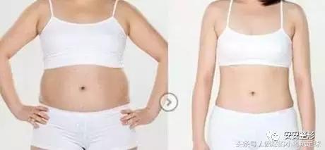 吸脂瘦身｜让你在夏天更美一点！
