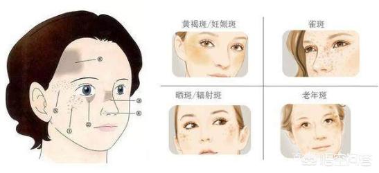 如何快速有效祛斑祛黑色素,怎样快速祛斑呢
