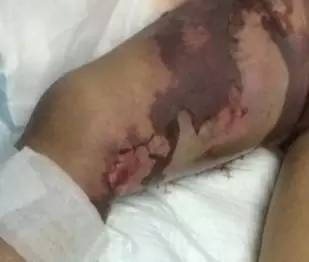 感冒脓毒血症,小孩感冒引起的脓毒血症