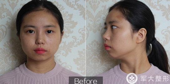 警惕微整形陷阱,整形美容的风险防范措施