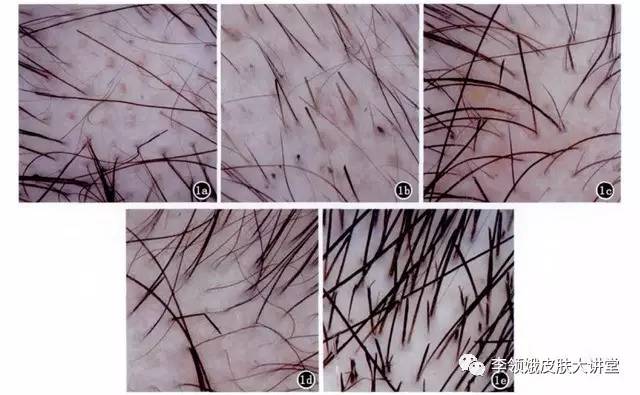 女人脱发怎么治,女孩秃发一般从哪里开始秃