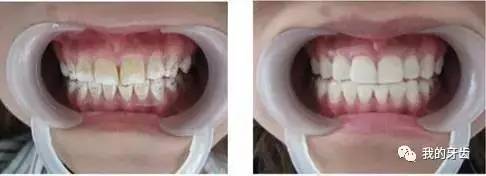 冷光美白牙齿靠谱吗,牙齿美白全过程视频