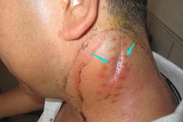 脖子淋巴结核是怎么回事,脖子上淋巴肿瘤是怎么回事