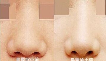鼻翼缩小鼻子更大,让鼻翼缩小的方法