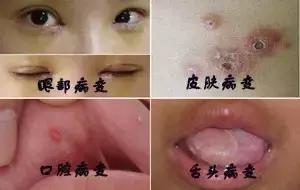 口腔溃疡30秒治好,猫口腔溃疡能治好吗