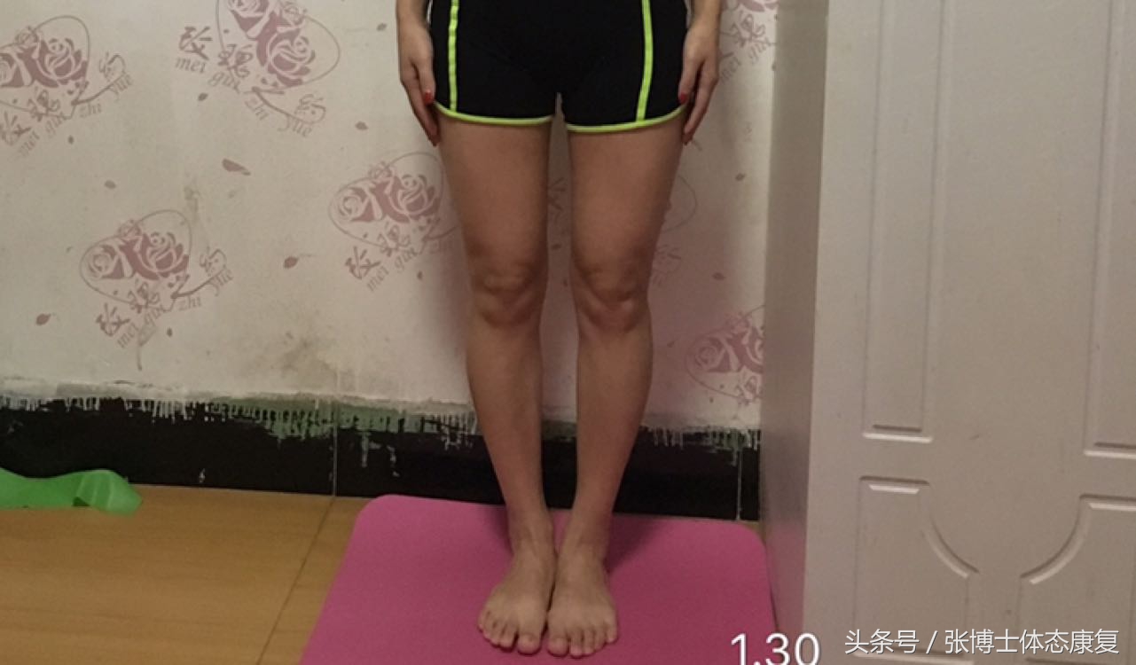 教你一招矫正o型腿,体态矫正康复训练