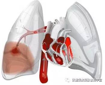 产后不下床，血栓把命夺