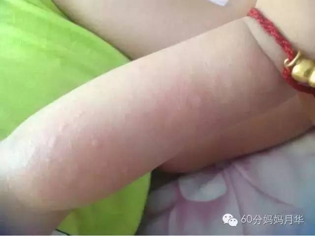 蚊子包止痒宝宝,怎么区分蚊子包和湿疹