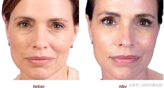 玻尿酸透明质酸危害,透明质酸注射液功效