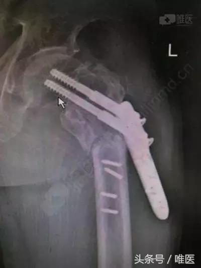 粗隆间骨折恢复全过程视频,粗隆间粉碎性骨折案例