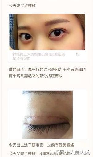 外科医生申霄,申霄医生双眼皮风格