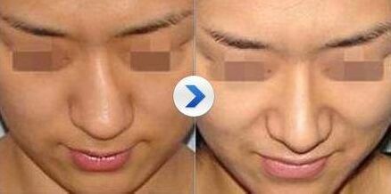 歪鼻子怎么办,歪鼻子有什么办法呢