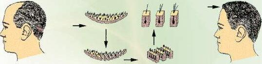 雍禾植发医院靠谱吗,大麦植发医院靠谱吗