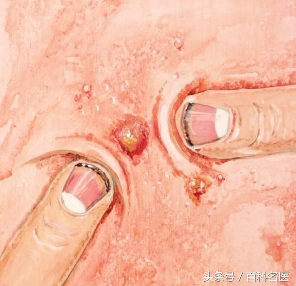 怎么抗痘痘最有效的方法,痘痘肌有效治理帮你轻松终结战痘