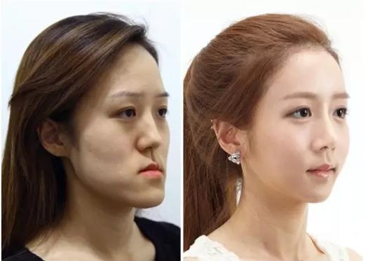 韩国整容手术恢复过程,韩国一个整容的综艺节目