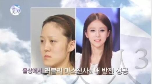 韩国整容手术恢复过程,韩国一个整容的综艺节目