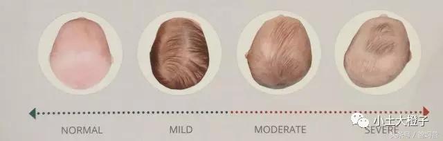 美国的宝宝扁头为什么要矫正,扁头在国外要做矫正吗