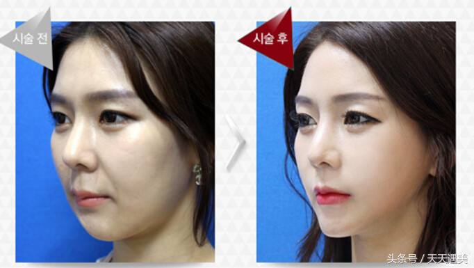 凸嘴到底有多可怕,突嘴是牙齿原因吗