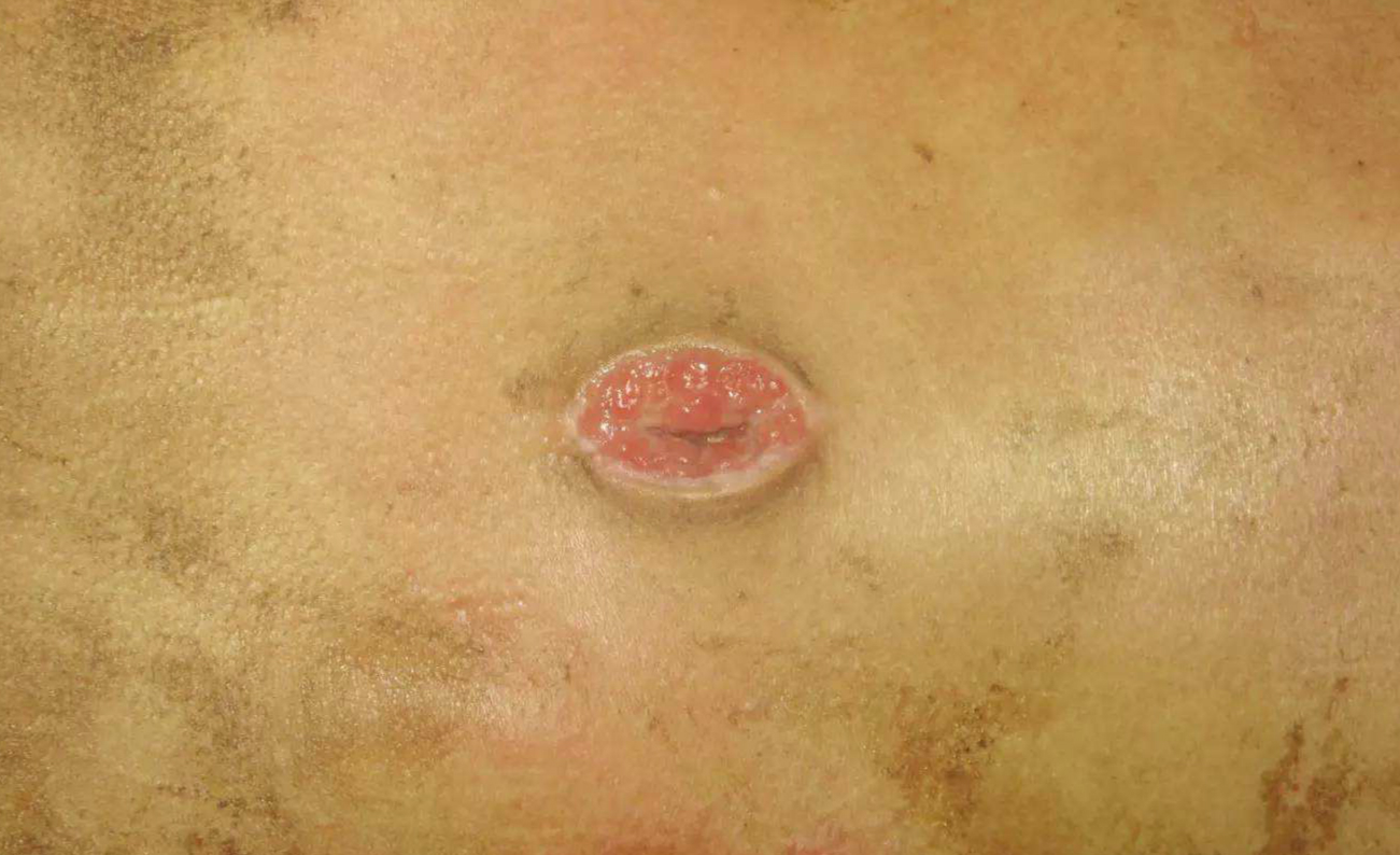 骨结核的十大忌讳,骨关节治疗的误区