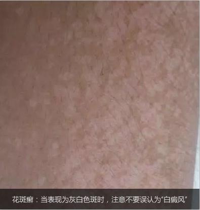白癜风诊断及鉴别诊断,白癜风的鉴别与诊断
