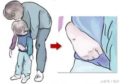 发生气道异物首选急救方法,气道异物抢救措施