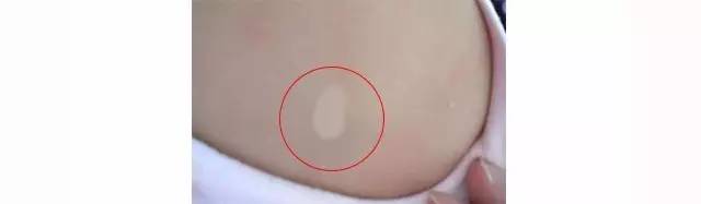 初生婴儿痣和胎记怎么区别,孩子长痣和胎记区别
