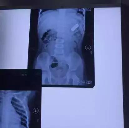 2岁男童误吞电池要做手术，急诊医生居然拿出导尿管！